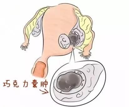 长了卵巢巧克力囊肿该怎么办